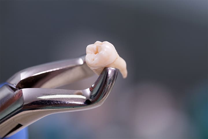 自分の歯を移植できる自家歯牙移植