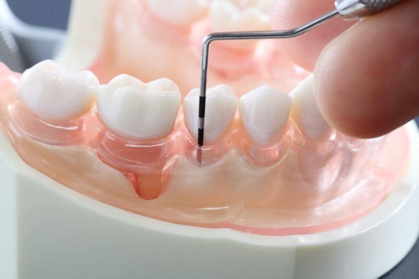 すべての土台:「歯周基本治療(SRP)」とその限界