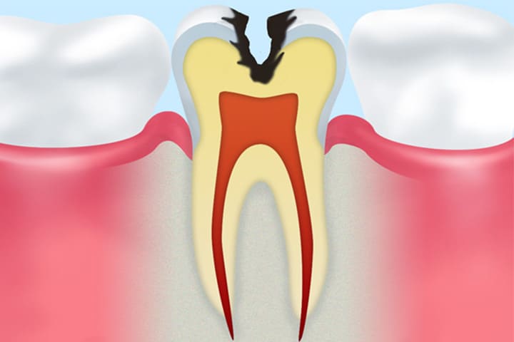 虫歯は放置しても治らない病気です