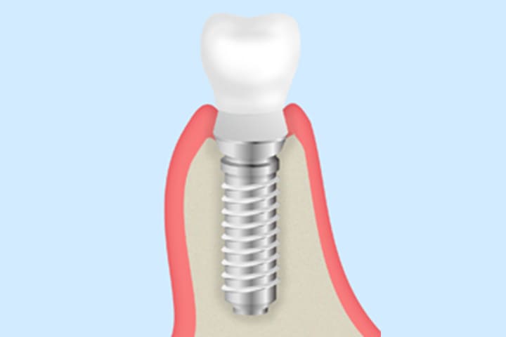 インプラントという選択肢