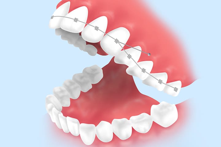 インプラントアンカー併用矯正：歯科矯正用アンカースクリュー