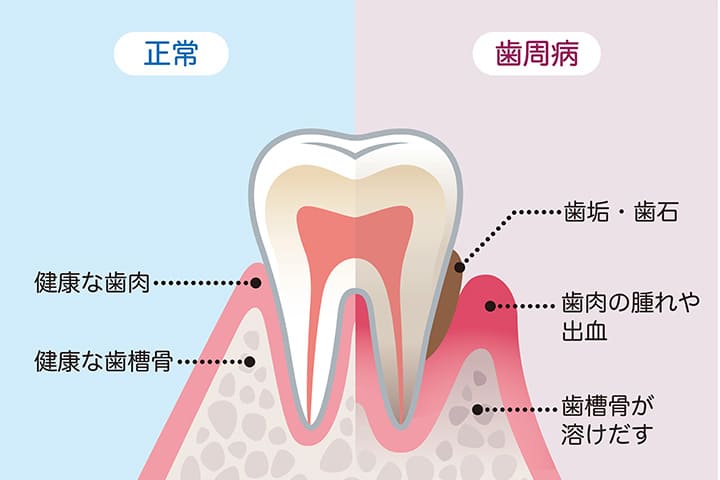 放置してはいけない歯周病