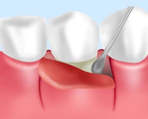 歯周ポケット掻破（そうは）術