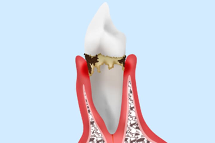 軽度歯周炎