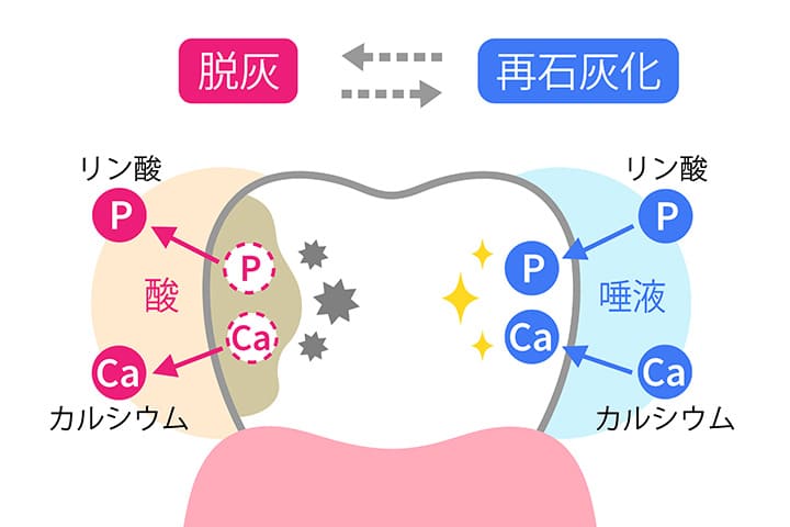 歯の再石灰化で初期の虫歯を防げます