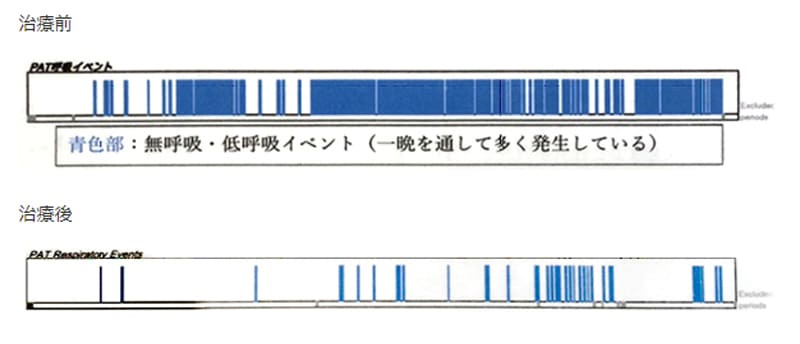 治療前後のマウスピース装着6か月経過時の睡眠検査データの比較