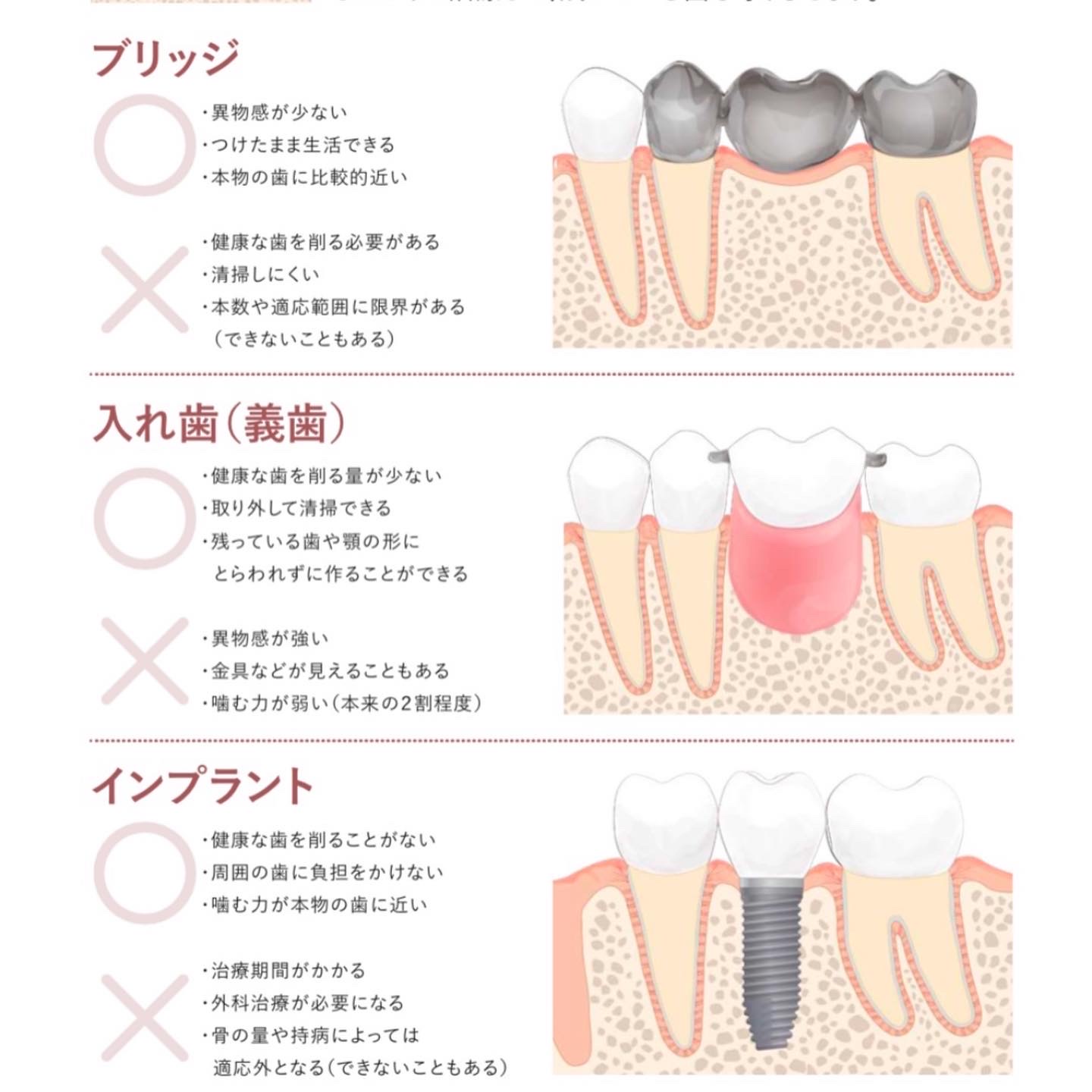 歯を失った後の治療方法について