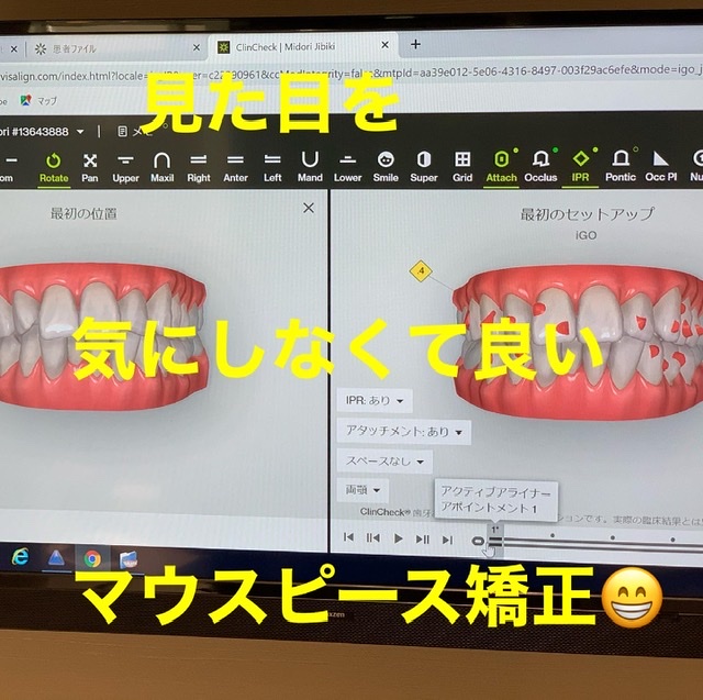 目立たない矯正😌