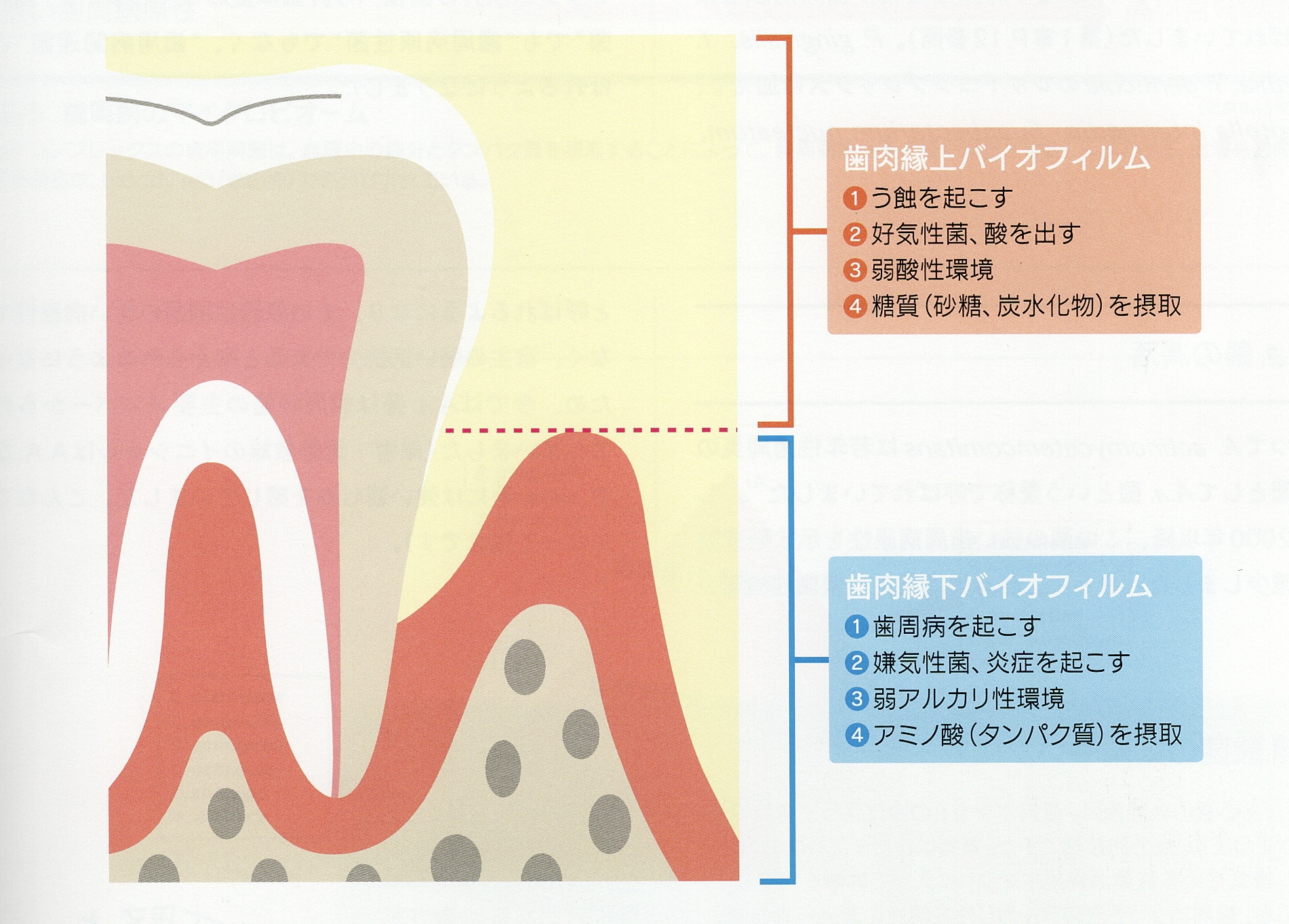 歯周病菌とむし歯菌のちがい