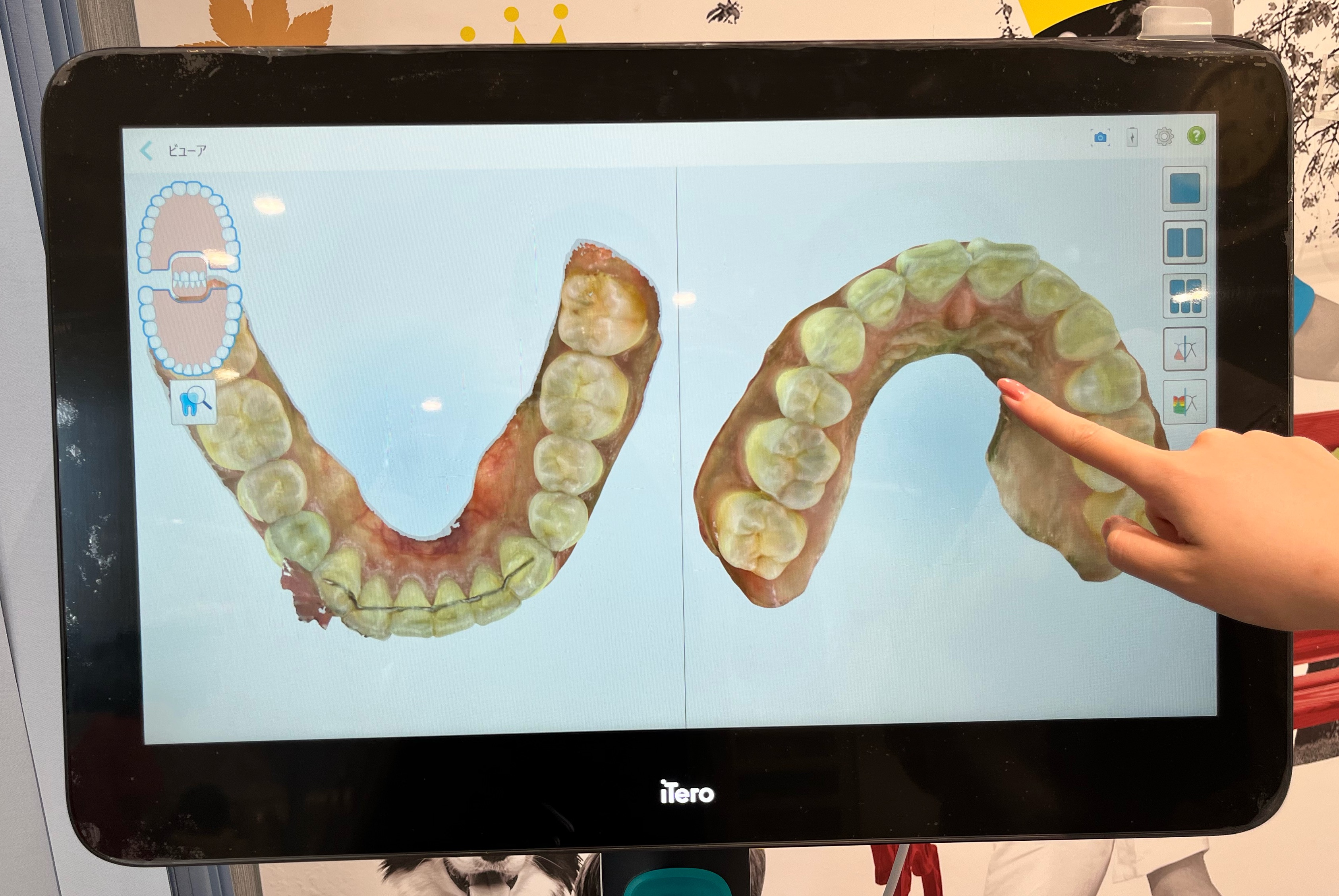 iTero導入しました！